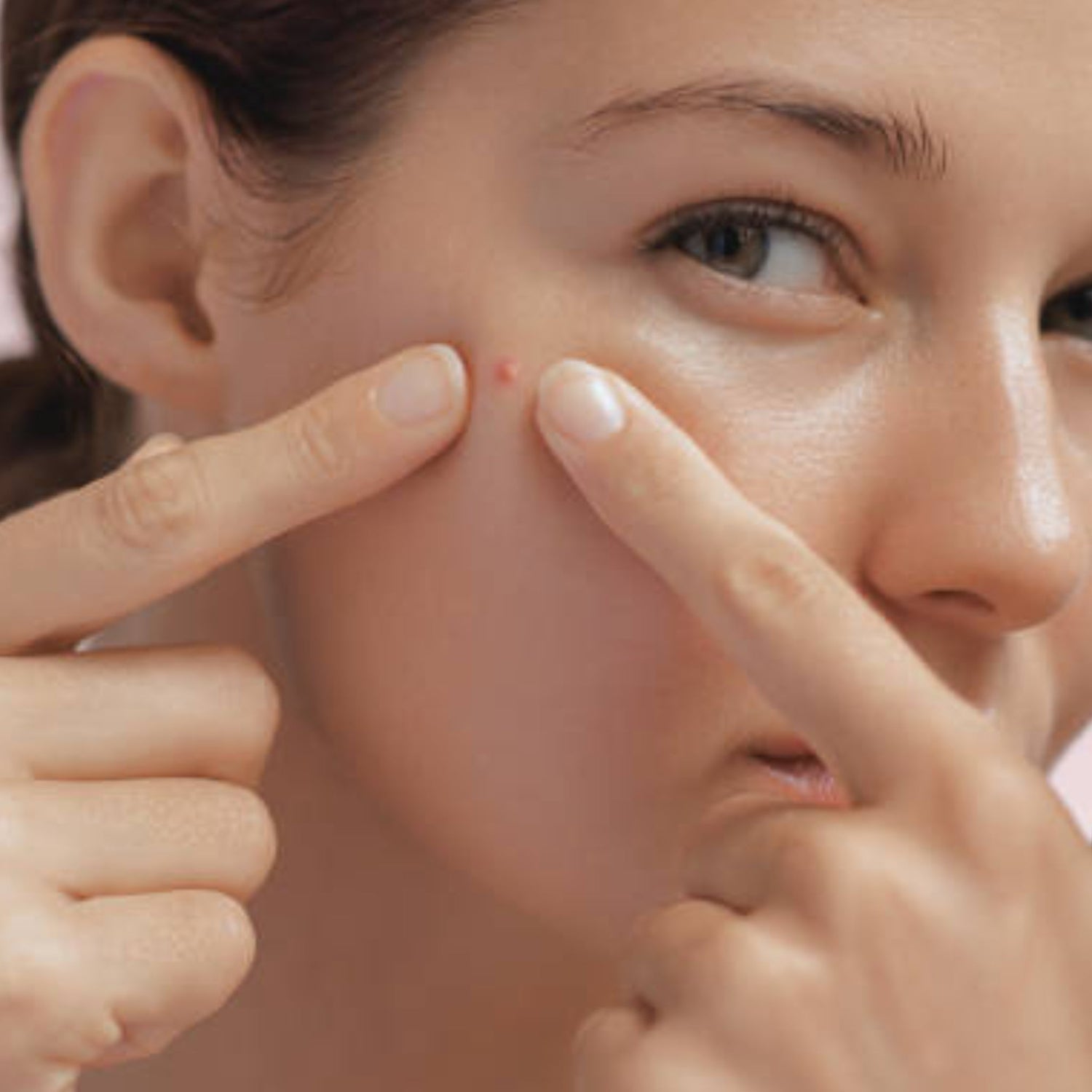 Acne, Blemishes & Blackheads